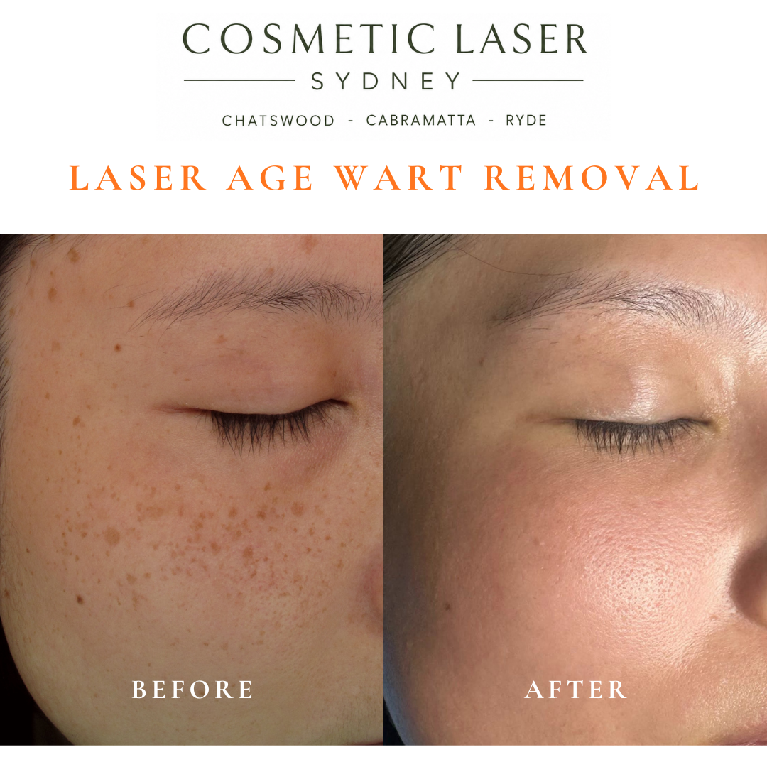 Cosmetic laser clinic in Sydney specialising in seborrhoeic keratosis and age wart laser removal for all skin types. See thousands of before and after photos.