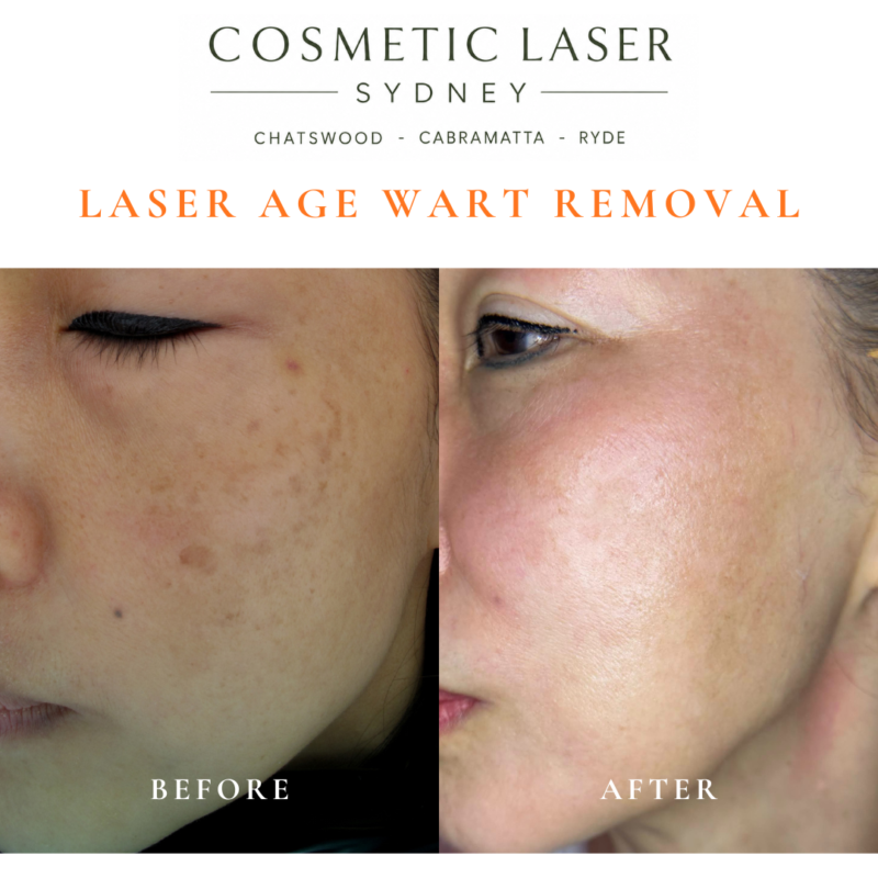 Cosmetic laser clinic in Sydney specialising in seborrhoeic keratosis and age wart laser removal for all skin types. See thousands of before and after photos.
