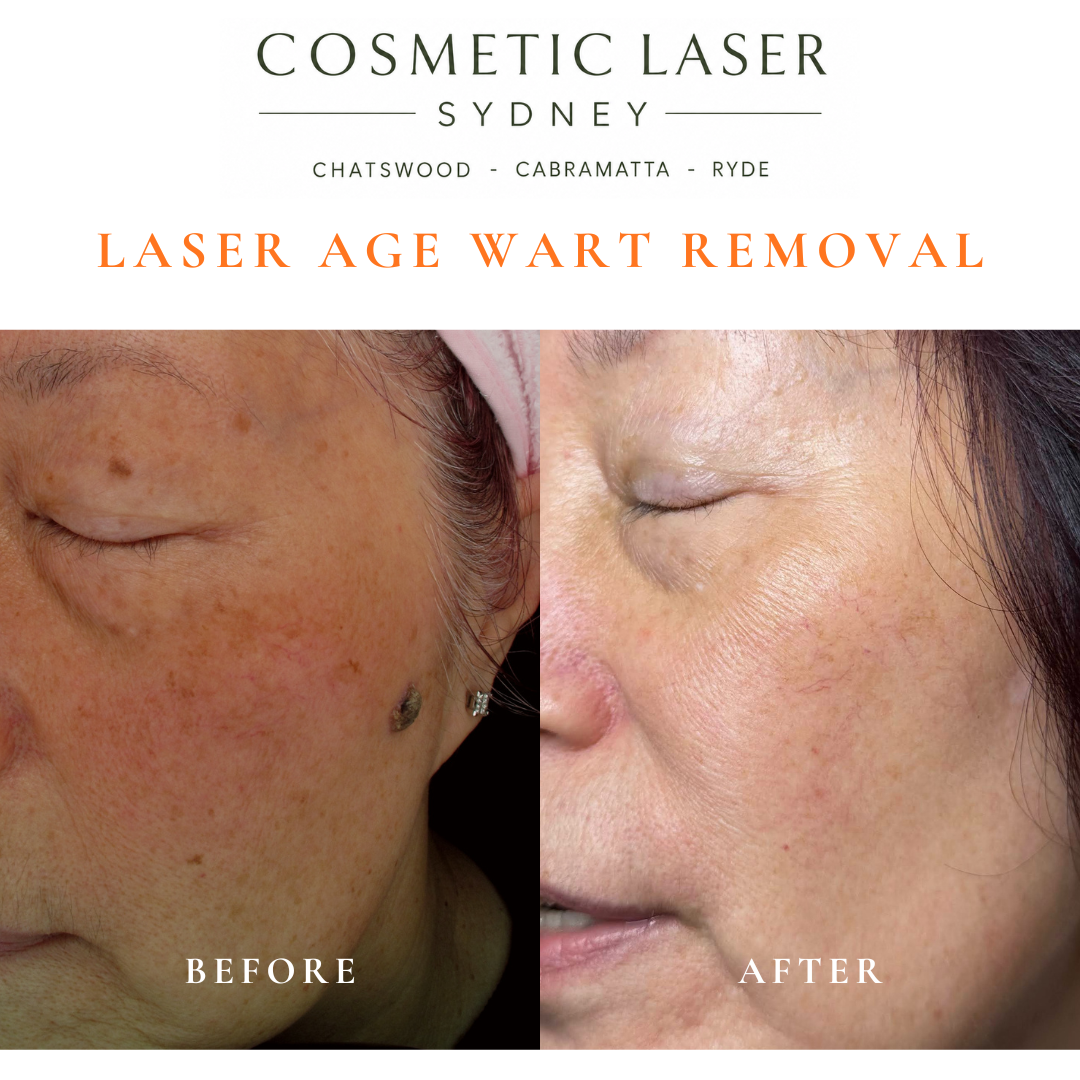 Cosmetic laser clinic in Sydney specialising in seborrhoeic keratosis and age wart laser removal for all skin types. See thousands of before and after photos.