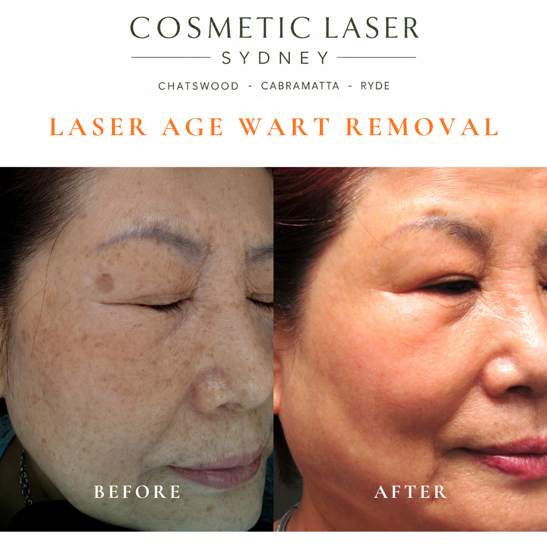 Cosmetic laser clinic in Sydney specialising in seborrhoeic keratosis and age wart laser removal for all skin types. See thousands of before and after photos.