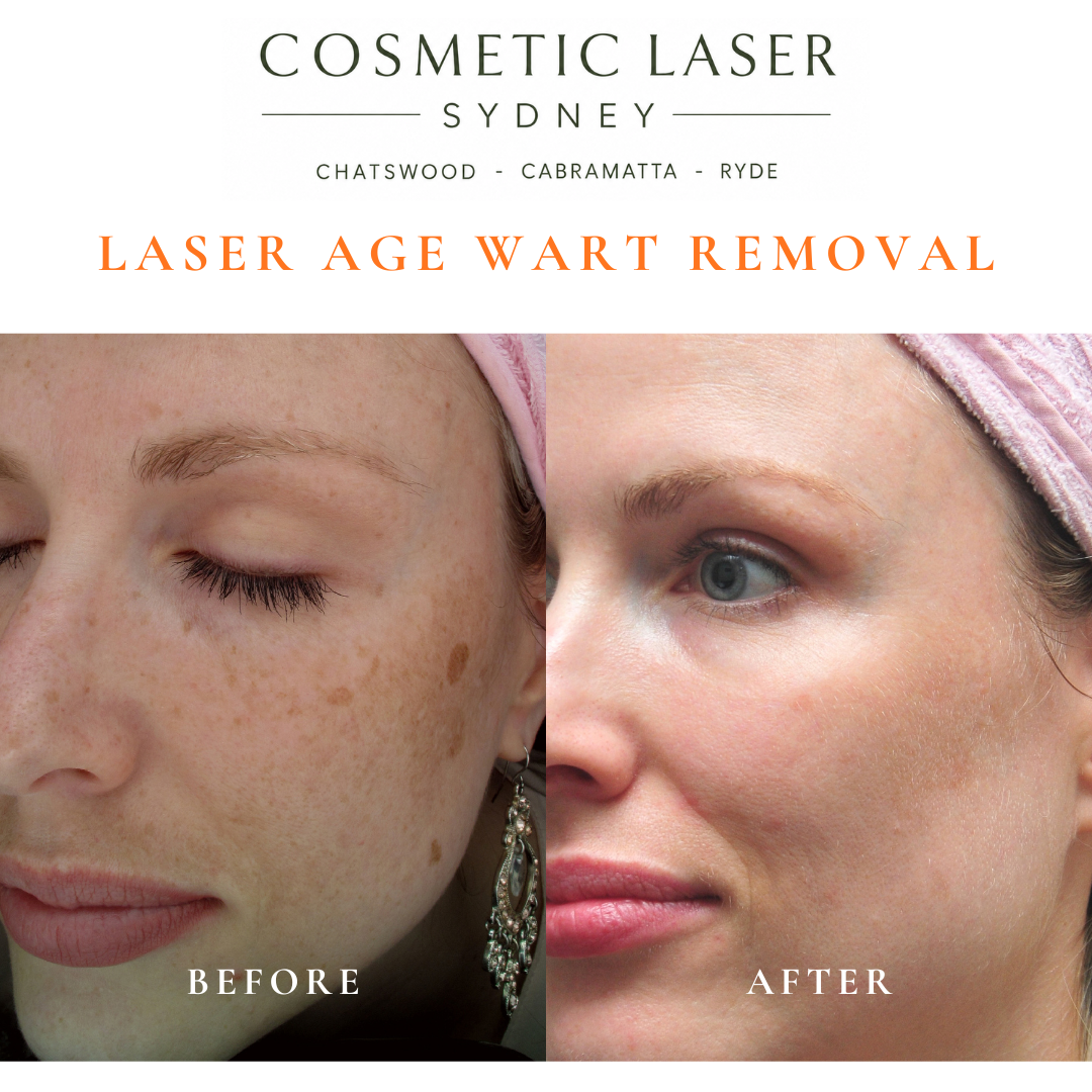 Cosmetic laser clinic in Sydney specialising in seborrhoeic keratosis and age wart laser removal for all skin types. See thousands of before and after photos.