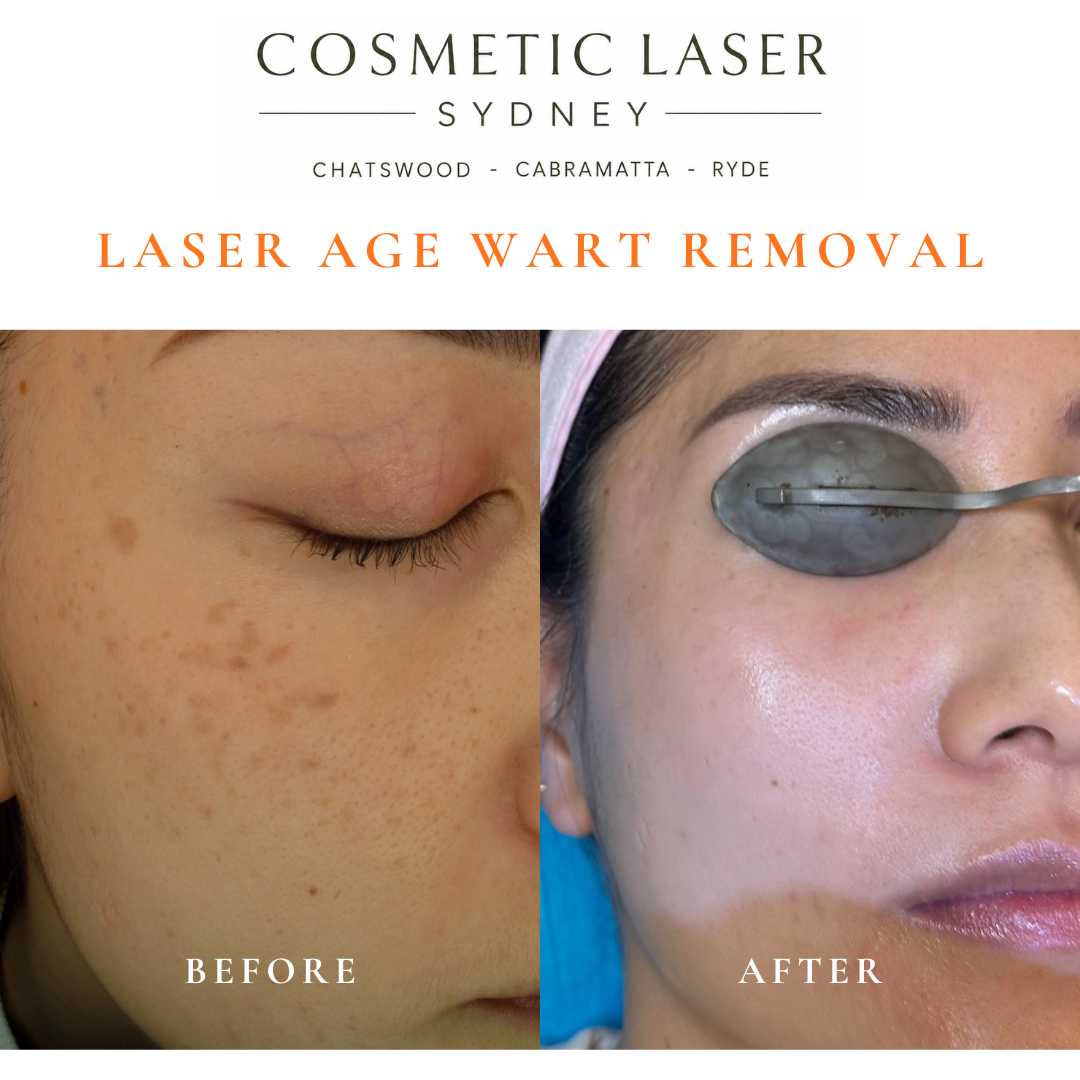 Cosmetic laser clinic in Sydney specialising in seborrhoeic keratosis and age wart laser removal for all skin types. See thousands of before and after photos.
