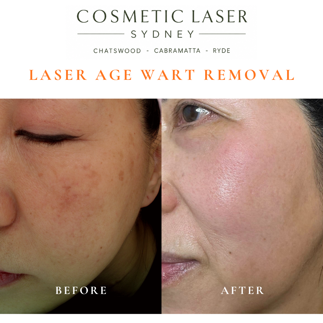 Cosmetic laser clinic in Sydney specialising in seborrhoeic keratosis and age wart laser removal for all skin types. See thousands of before and after photos.