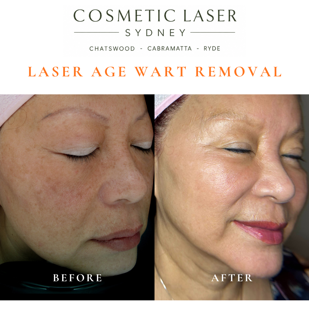 Cosmetic laser clinic in Sydney specialising in seborrhoeic keratosis and age wart laser removal for all skin types. See thousands of before and after photos.