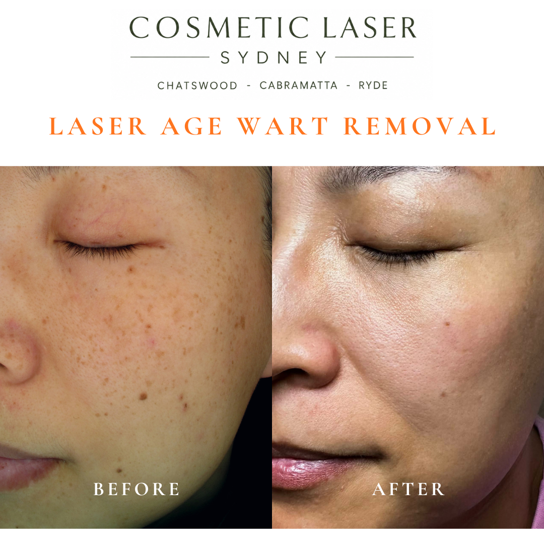 Cosmetic laser clinic in Sydney specialising in seborrhoeic keratosis and age wart laser removal for all skin types. See thousands of before and after photos.