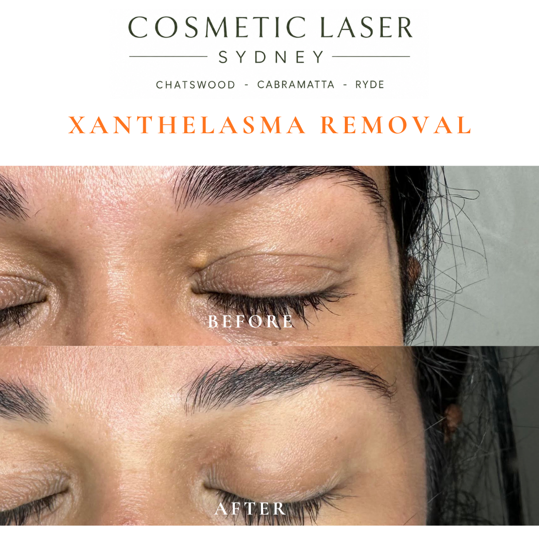 Before and after laser xanthelasma removal by Dr Peter Kim at Cosmetic Laser Sydney Chatswood, Cabramatta & Ryde