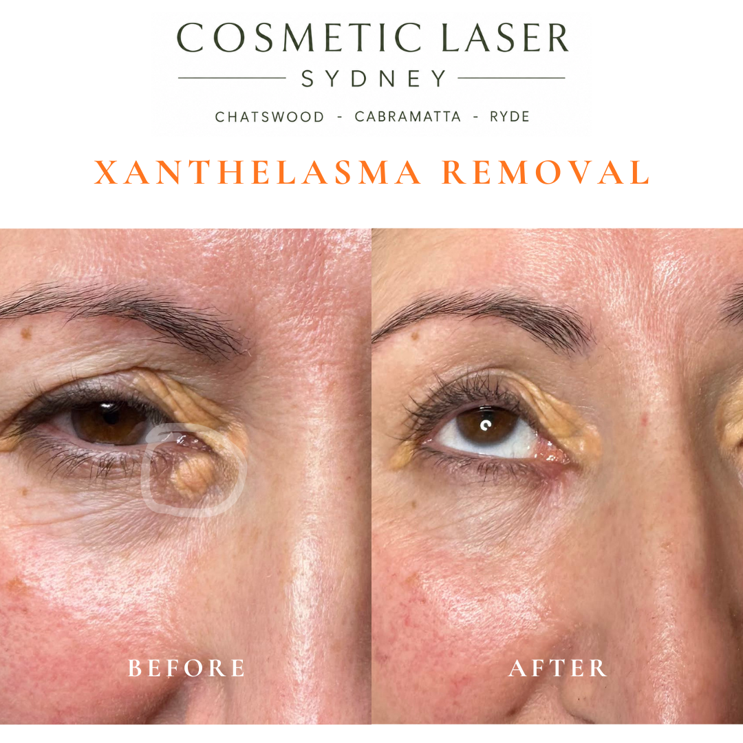 Before and after laser xanthelasma removal by Dr Peter Kim at Cosmetic Laser Sydney Chatswood, Cabramatta & Ryde