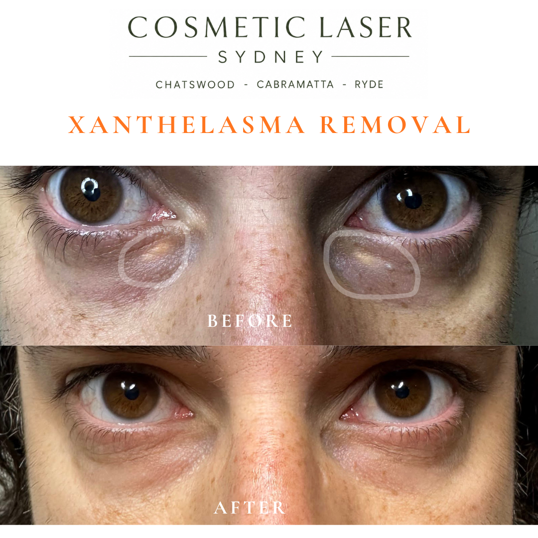 before and after photo after laser xanthelasma removal in sydney by dr peter kim chatswood and cabramatta