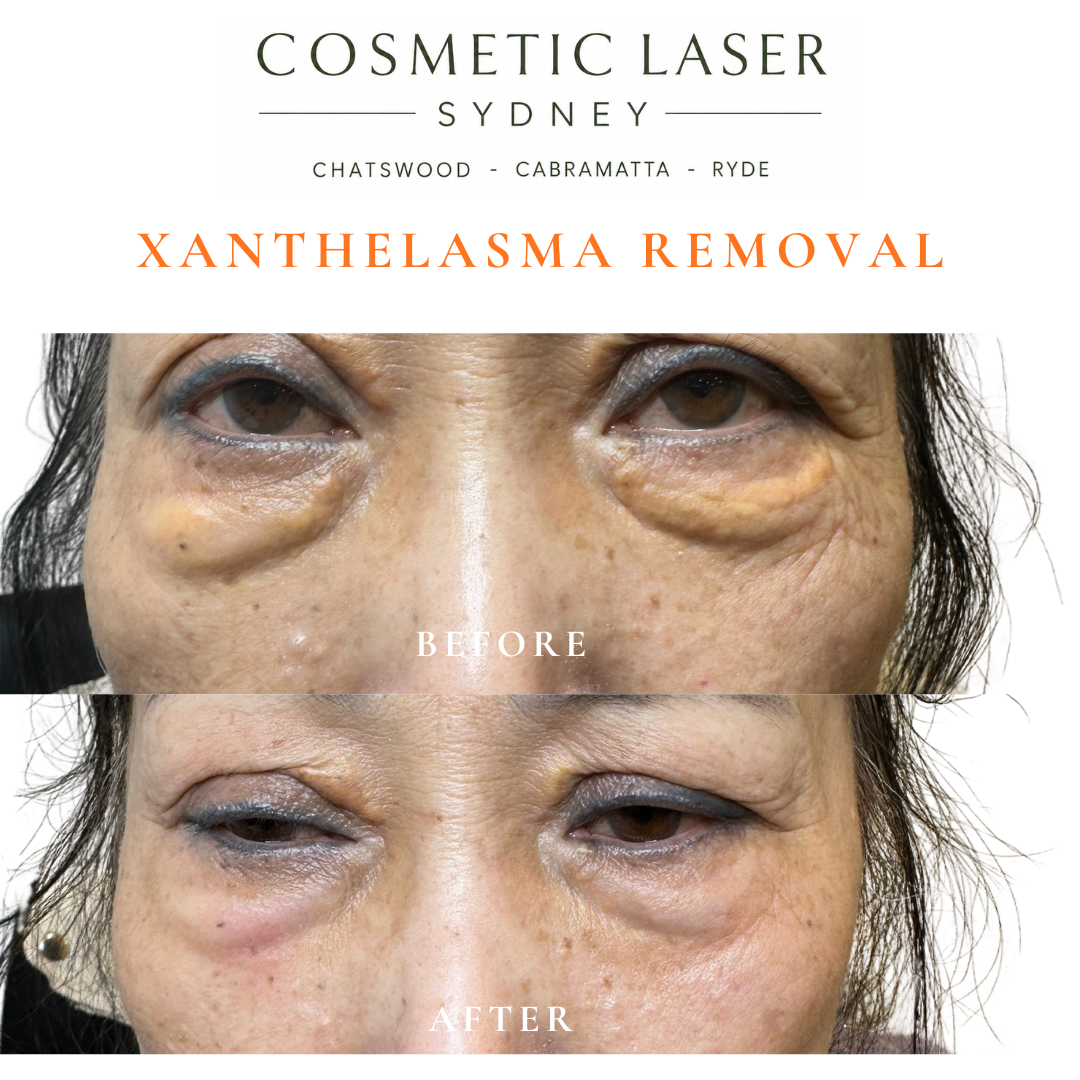 Before and after laser xanthelasma removal by Dr Peter Kim at Cosmetic Laser Sydney Chatswood, Cabramatta & Ryde