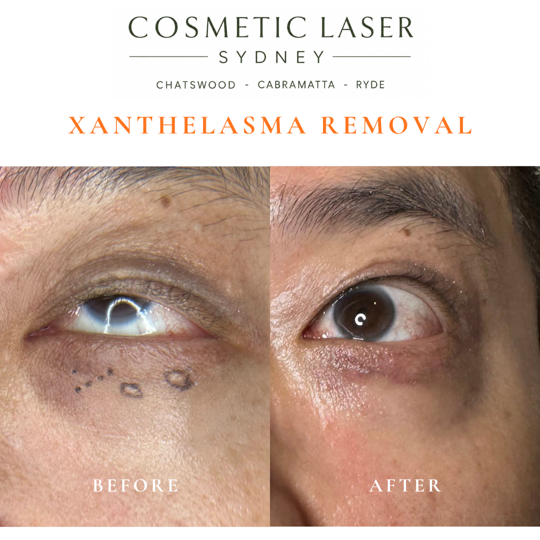 before and after photo after laser xanthelasma removal in sydney by dr peter kim chatswood and cabramatta