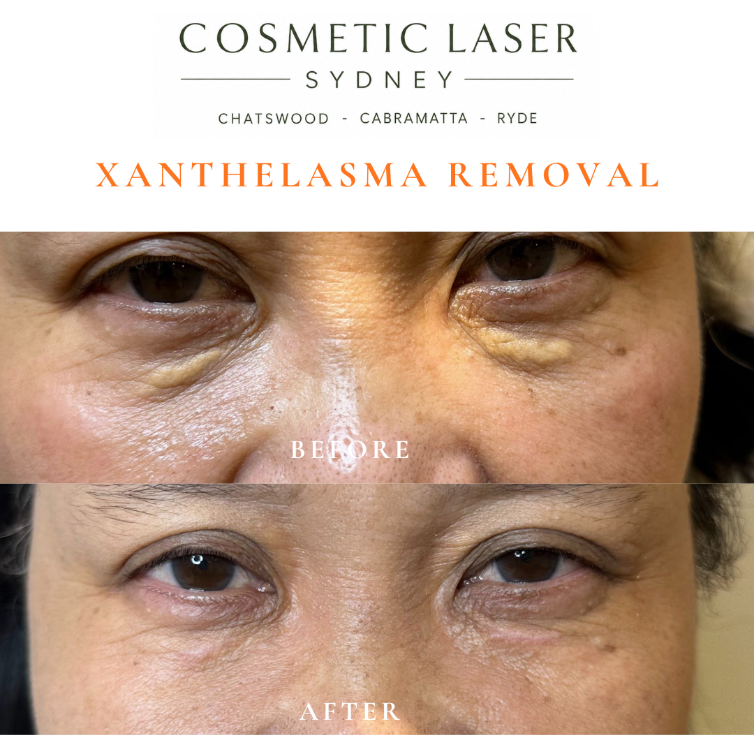 Before and after laser xanthelasma removal by Dr Peter Kim at Cosmetic Laser Sydney Chatswood, Cabramatta & Ryde
