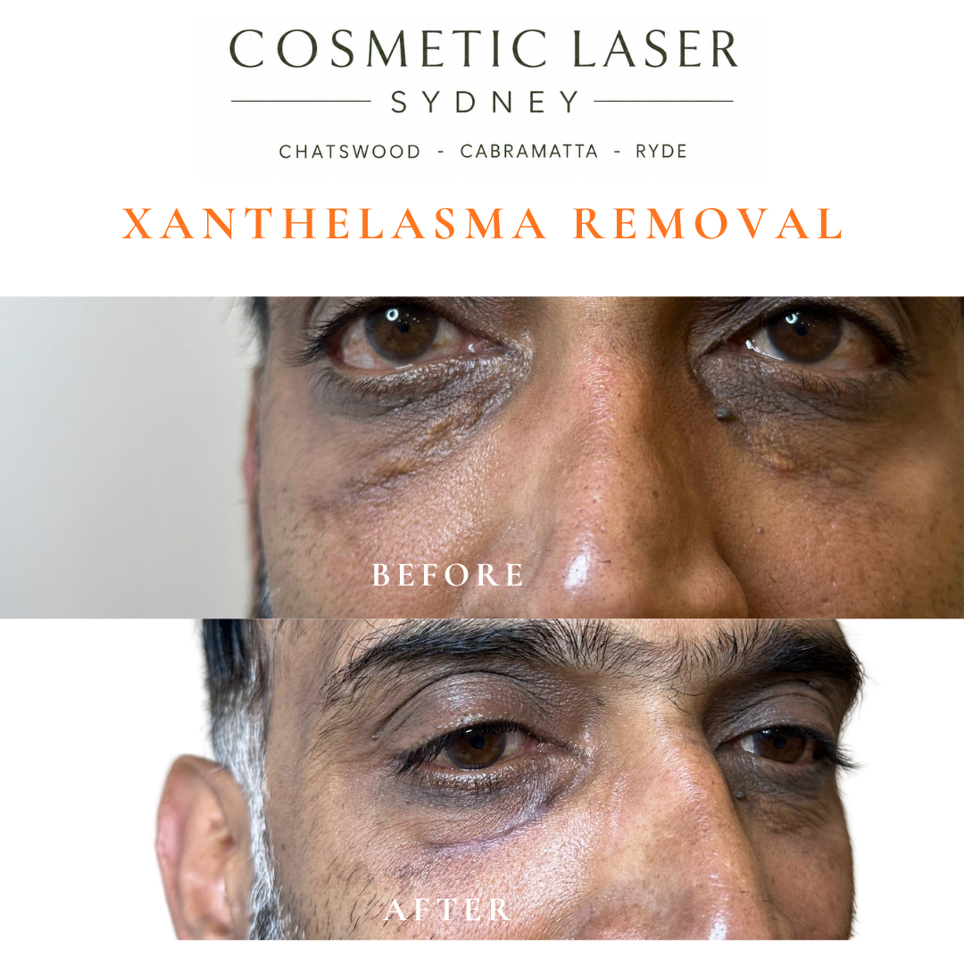 Before and after laser xanthelasma removal by Dr Peter Kim at Cosmetic Laser Sydney Chatswood, Cabramatta & Ryde