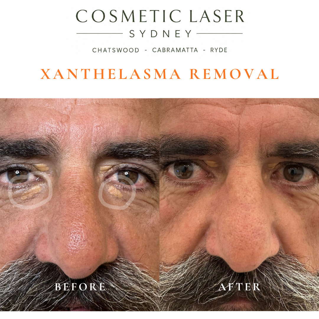 Before and after laser xanthelasma removal by Dr Peter Kim at Cosmetic Laser Sydney Chatswood, Cabramatta & Ryde