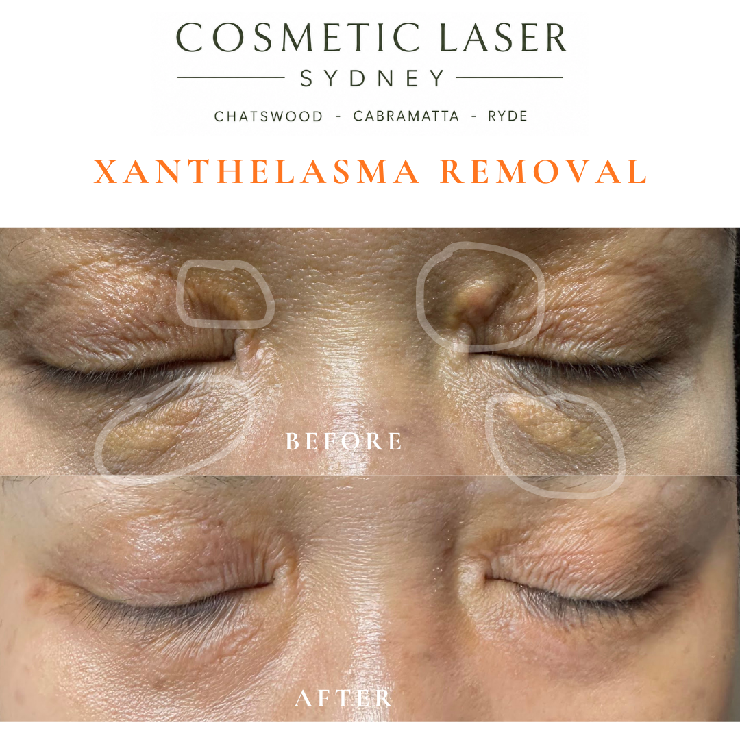 before and after photo after laser xanthelasma removal in sydney by dr peter kim chatswood and cabramatta