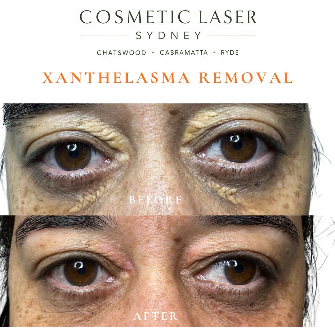 before and after photo after laser xanthelasma removal in sydney by dr peter kim chatswood and cabramatta
