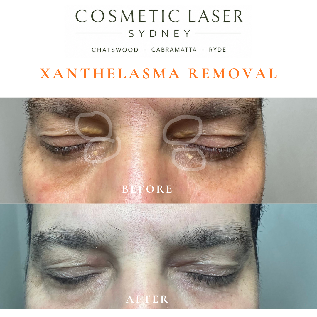 Before and after laser xanthelasma removal by Dr Peter Kim at Cosmetic Laser Sydney Chatswood, Cabramatta & Ryde