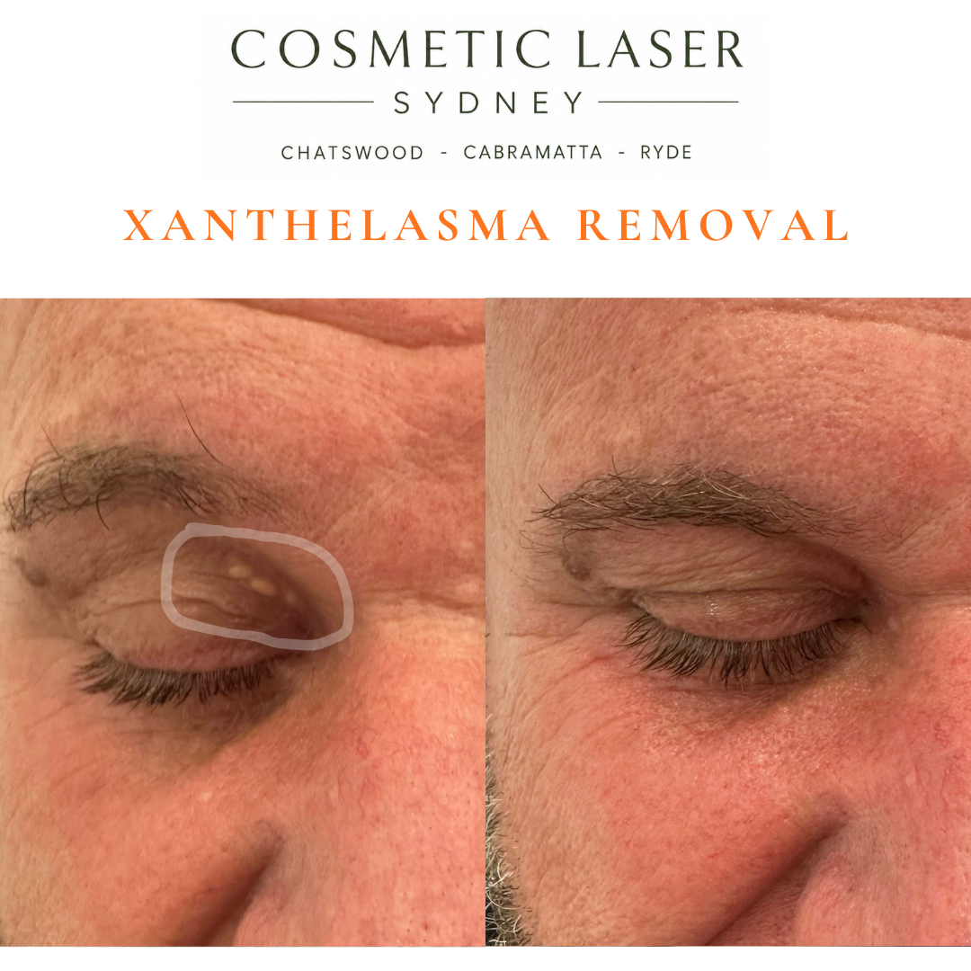 Before and after laser xanthelasma removal by Dr Peter Kim at Cosmetic Laser Sydney Chatswood, Cabramatta & Ryde