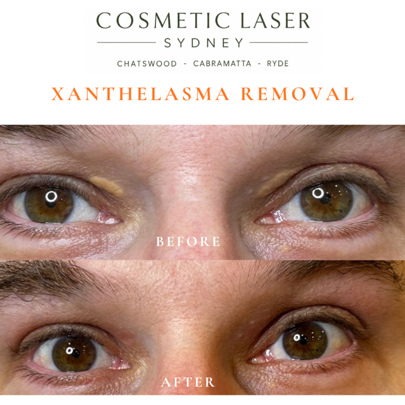Before and after laser xanthelasma removal by Dr Peter Kim at Cosmetic Laser Sydney Chatswood, Cabramatta & Ryde