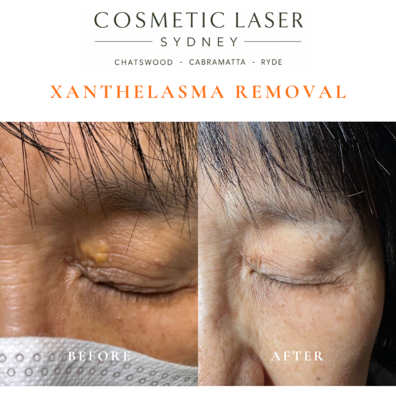 Before and after laser xanthelasma removal by Dr Peter Kim at Cosmetic Laser Sydney Chatswood, Cabramatta & Ryde