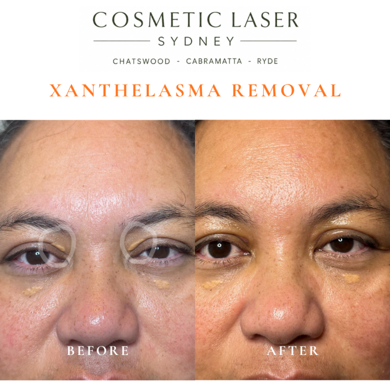 Before and after laser xanthelasma removal by Dr Peter Kim at Cosmetic Laser Sydney Chatswood, Cabramatta & Ryde