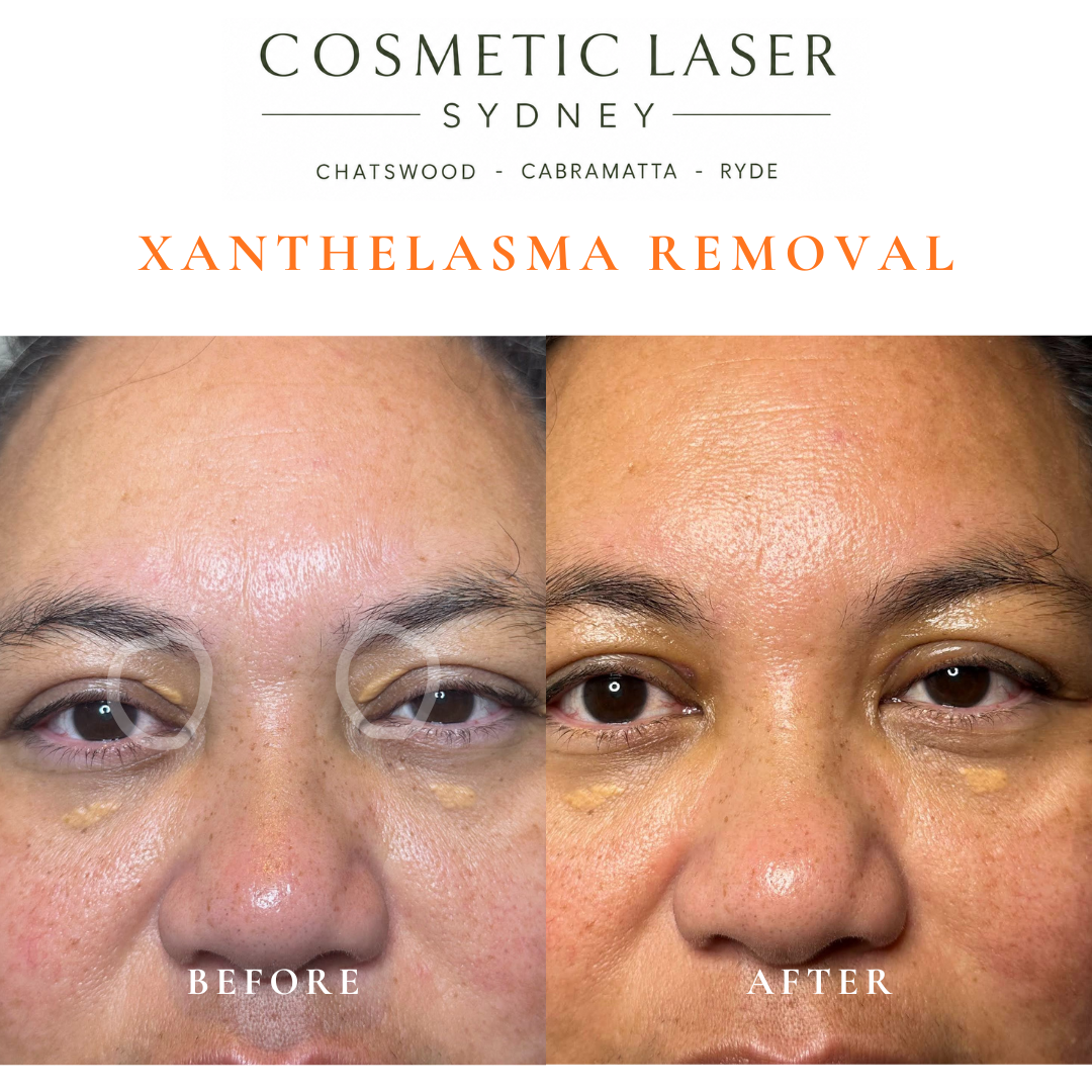 Before and after laser xanthelasma removal by Dr Peter Kim at Cosmetic Laser Sydney Chatswood, Cabramatta & Ryde