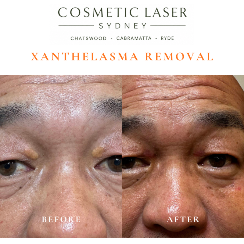 Before and after laser xanthelasma removal by Dr Peter Kim at Cosmetic Laser Sydney Chatswood, Cabramatta & Ryde