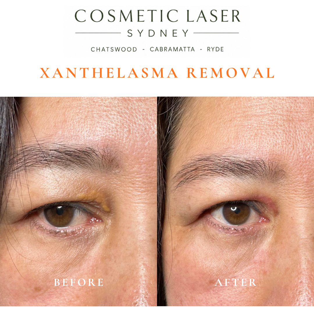 Xanthelasma removed from both upper eyelids after single laser session by Dr Peter Kim in an Asian & Ethinic skin type - Chatswood, Cabramatta & Ryde