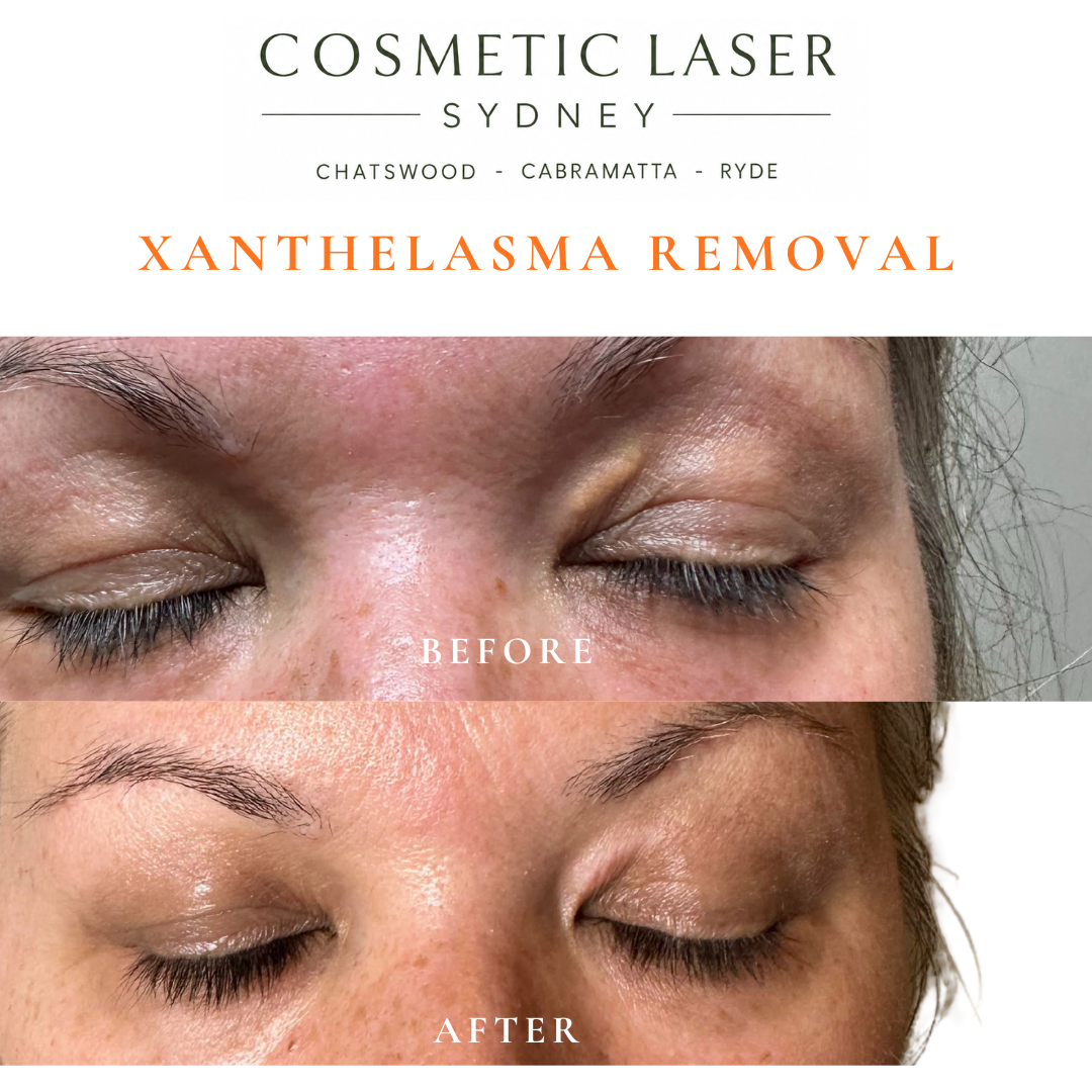 Before and after laser xanthelasma removal by Dr Peter Kim at Cosmetic Laser Sydney Chatswood, Cabramatta & Ryde
