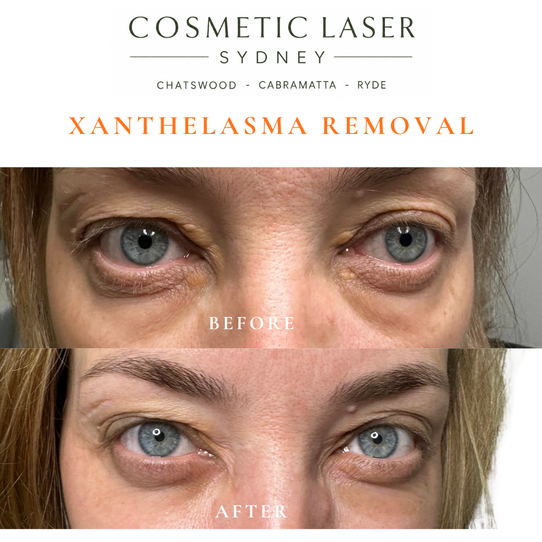 Before and after laser xanthelasma removal by Dr Peter Kim at Cosmetic Laser Sydney Chatswood, Cabramatta & Ryde
