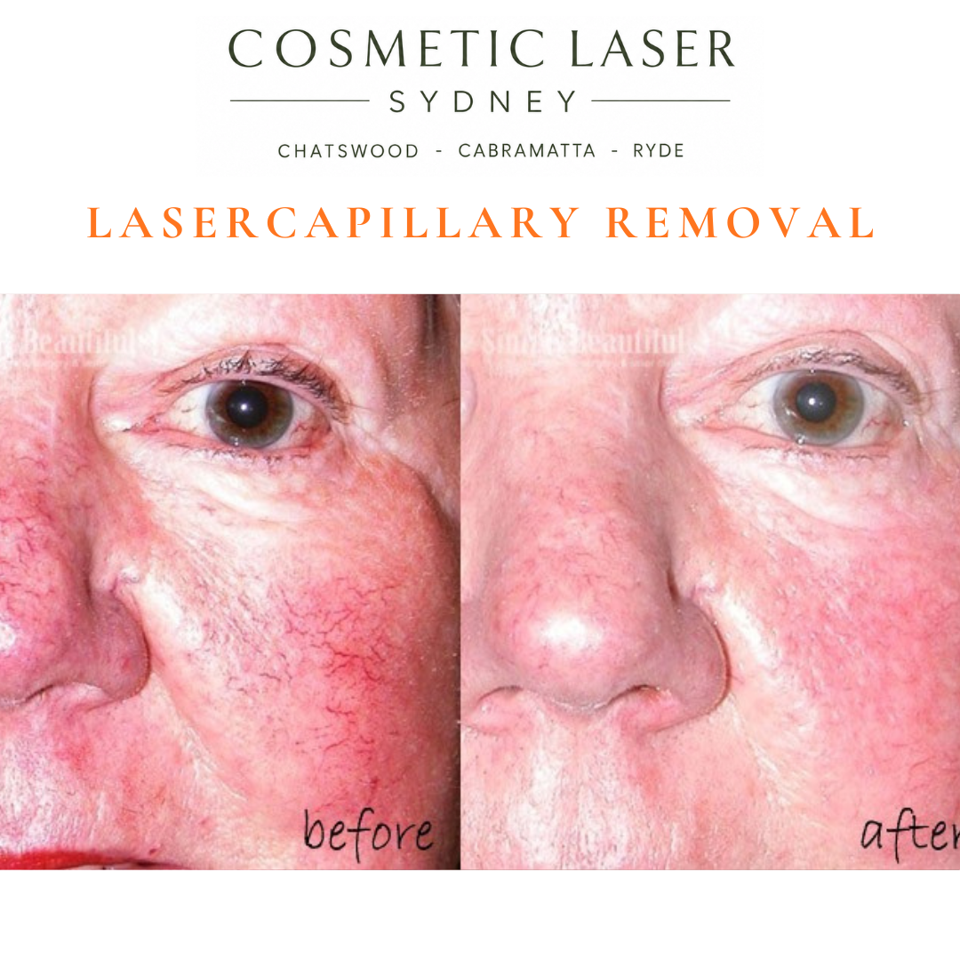 broken capillaries and talengictasia of the face and cheek and nose removal before and after vascular laser treatment by Dr Peter Kim Cosmetic Laser Sydney Chatswood Cabramatta Ryde