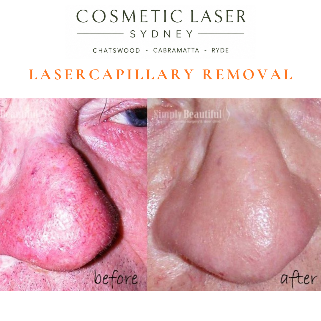 broken capillaries and talengictasia of the nose removal before and after vascular laser treatment by Dr Peter Kim Cosmetic Laser Sydney Chatswood Cabramatta Ryde