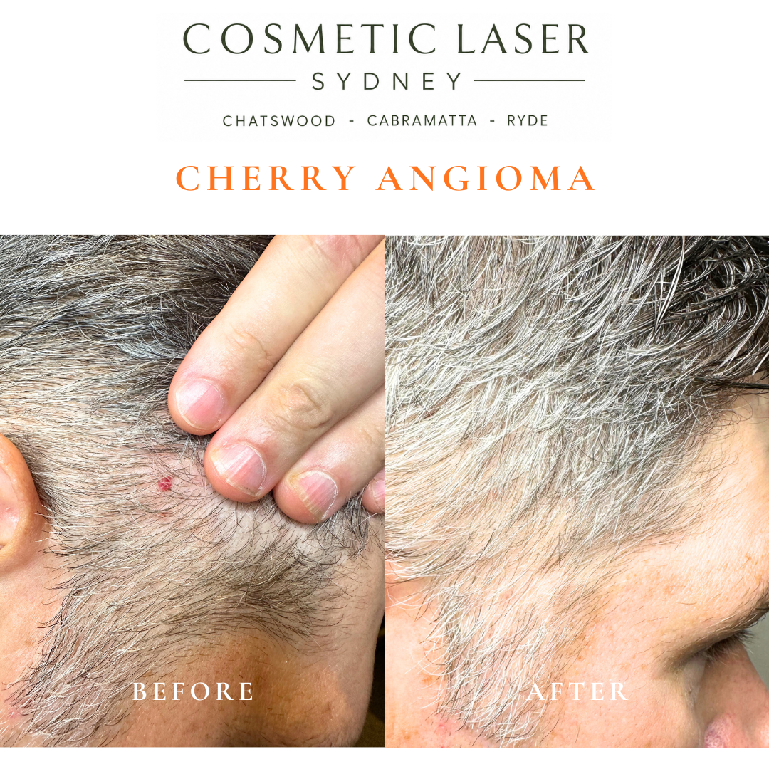 Cherry angioma or campbell de morgan spot of the temple removal before and after vascular laser treatment by Dr Peter Kim Cosmetic Laser Sydney Chatswood Cabramatta Ryde