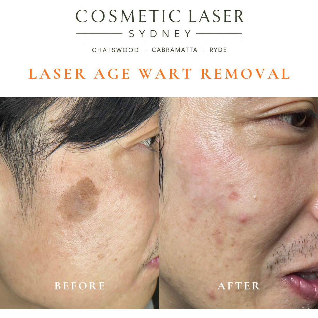 before after photos after laser wart removal on asian face