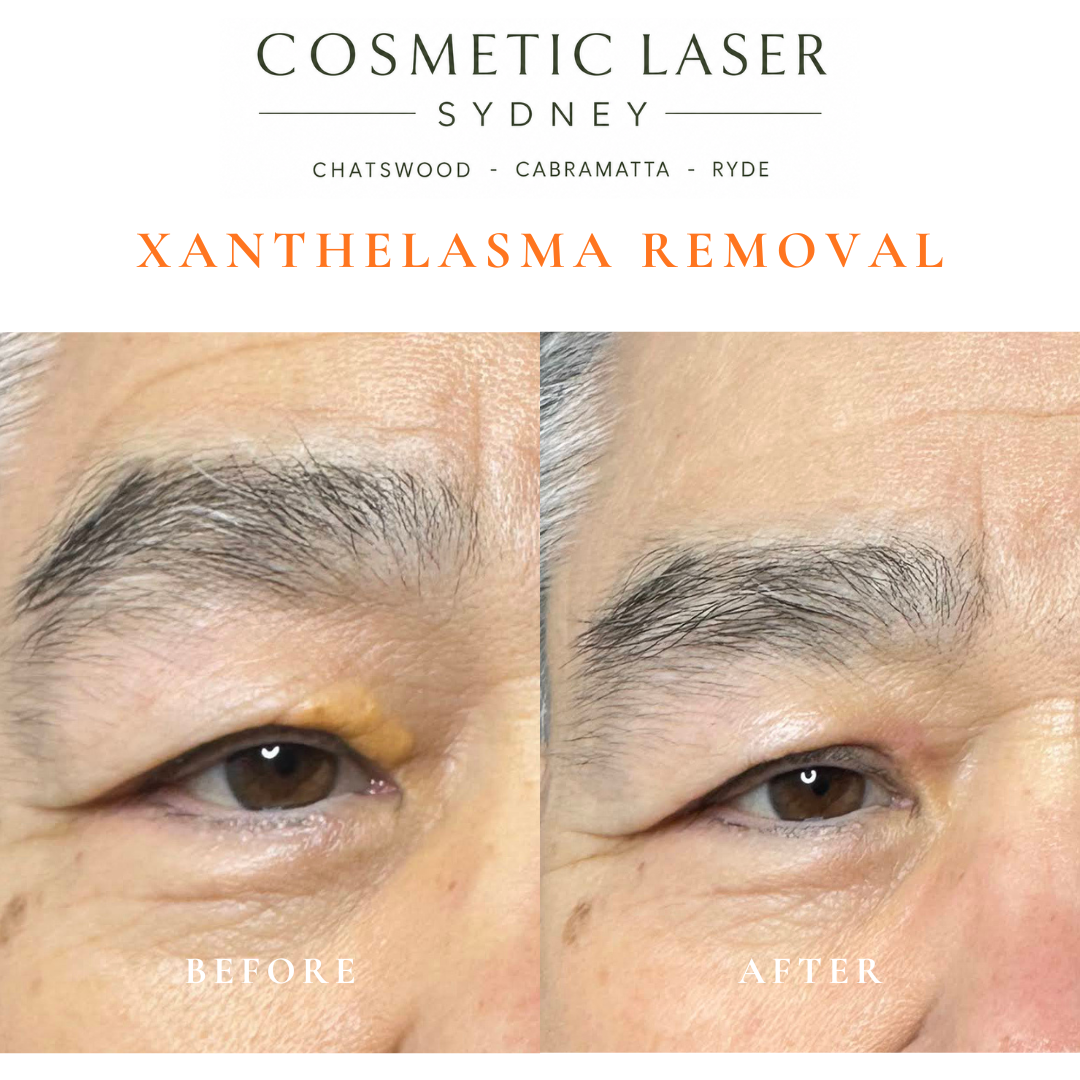 before and after photo after laser xanthelasma removal in sydney by dr peter kim chatswood and cabramatta