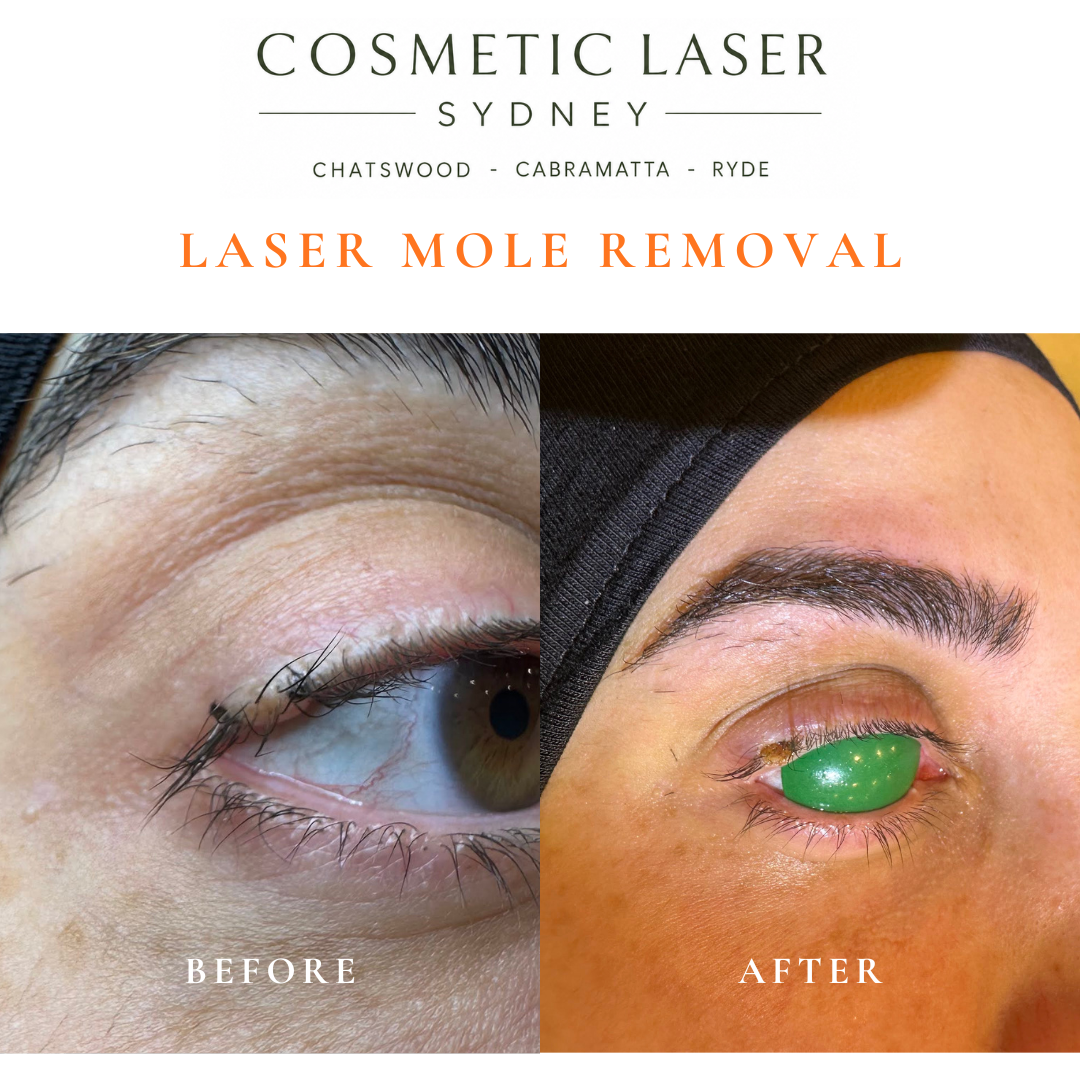 before after photos of mole removal in the eyelid by dr peter kim with laser mole removal technique in sydney