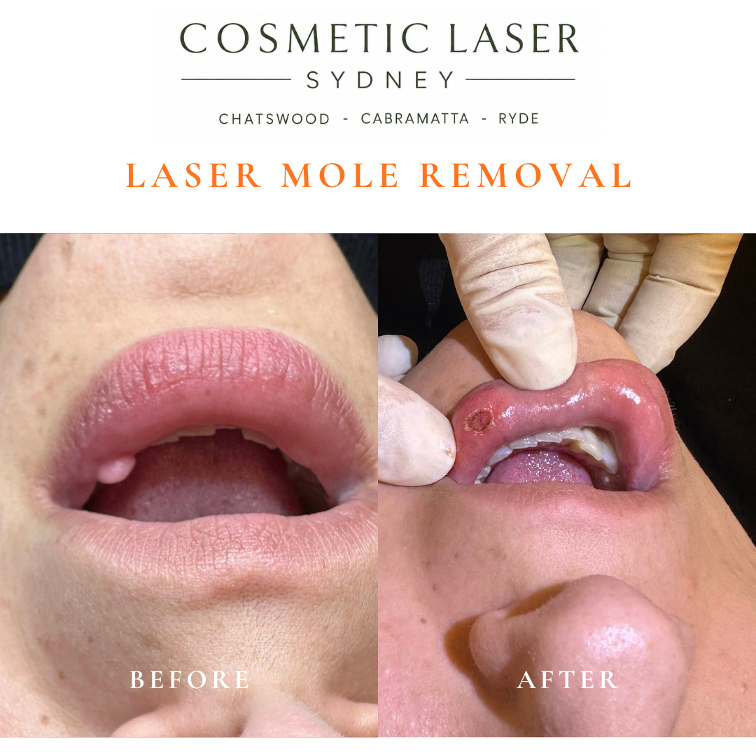 before after photo aof removal of mole inside the mouth by dr peter kim in sydney