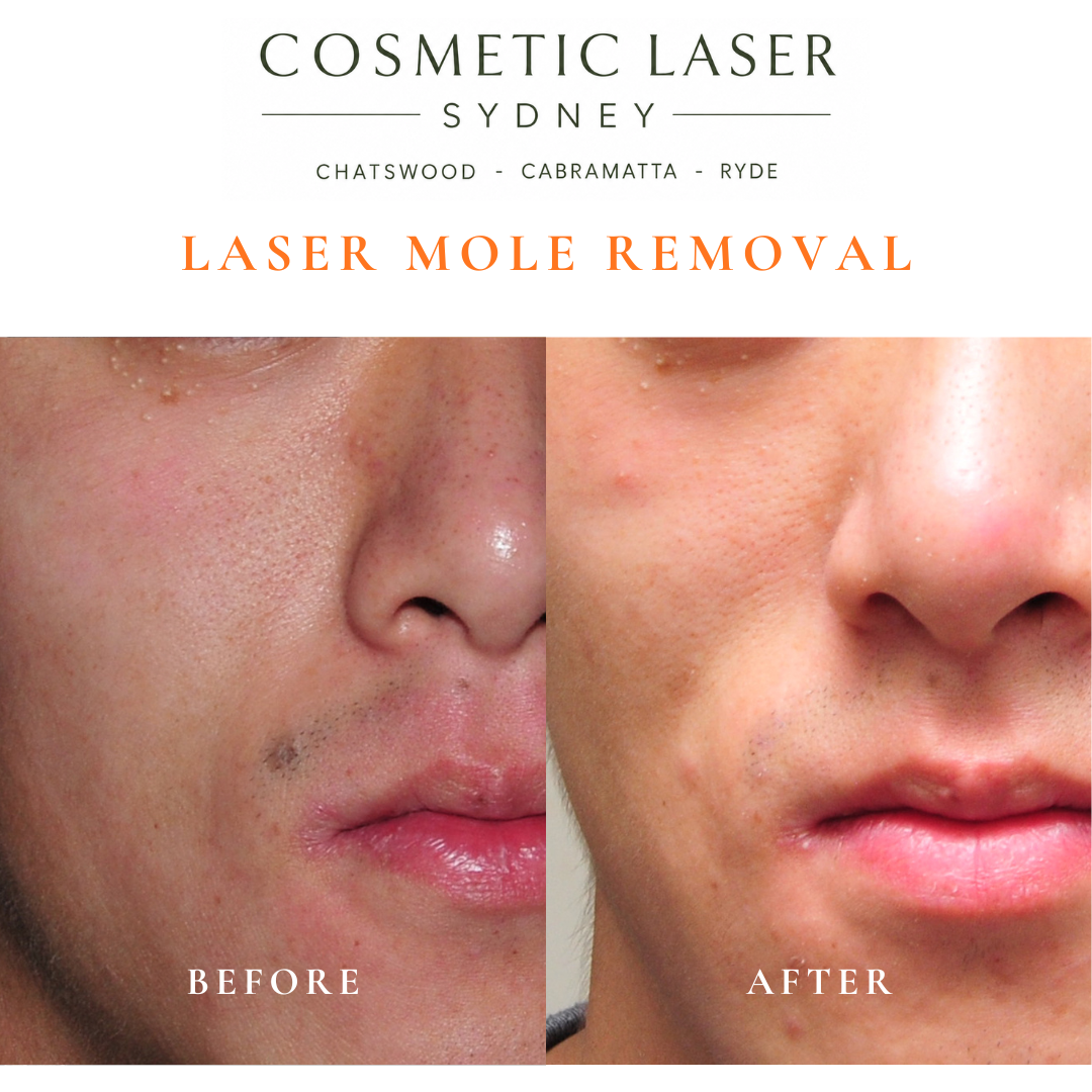 Mole on upper lip removed using laser mole removal treatment.