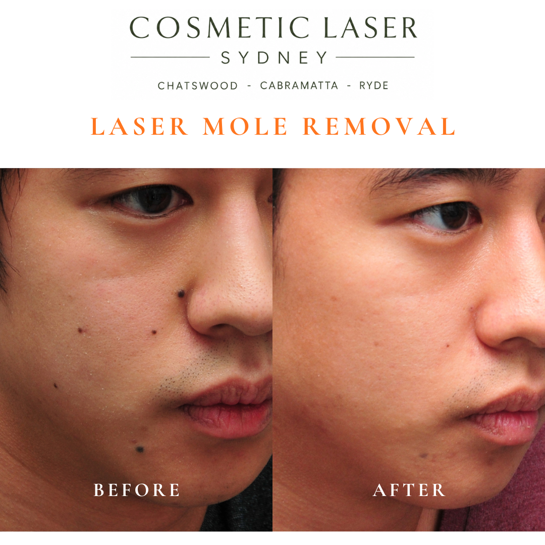 Multiple facial moles removed with laser treatment. In Asian skin, deeper pigmented moles frequently require several laser sessions for optimal results, making treatment more complex and potentially more costly.