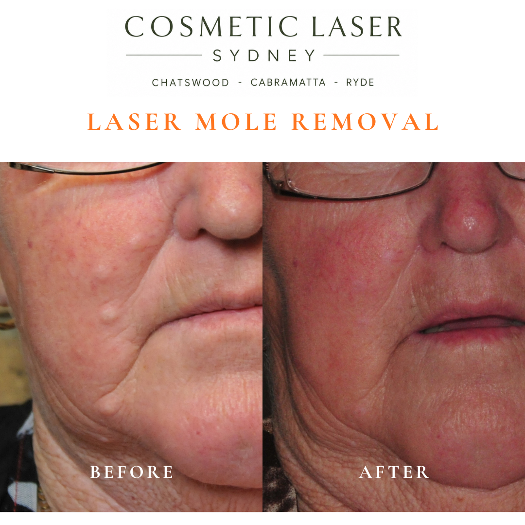 Four facial moles on the left side of the face before laser mole removal treatment.