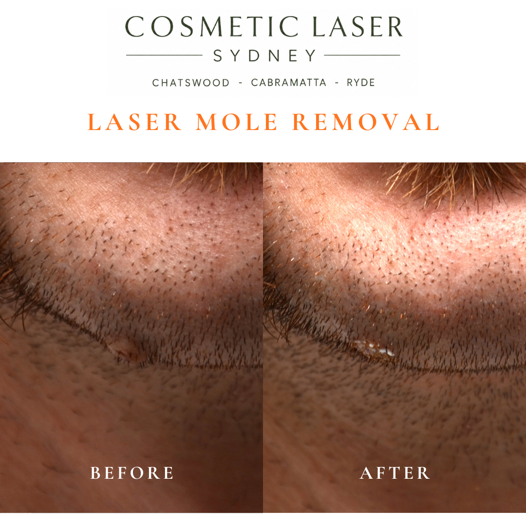 Photo showing immediately after the laser mole removal in the chin area.