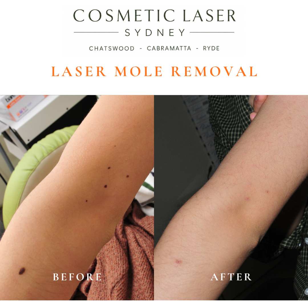 Multiple moles on the forearm and elbow treated with laser mole removal.