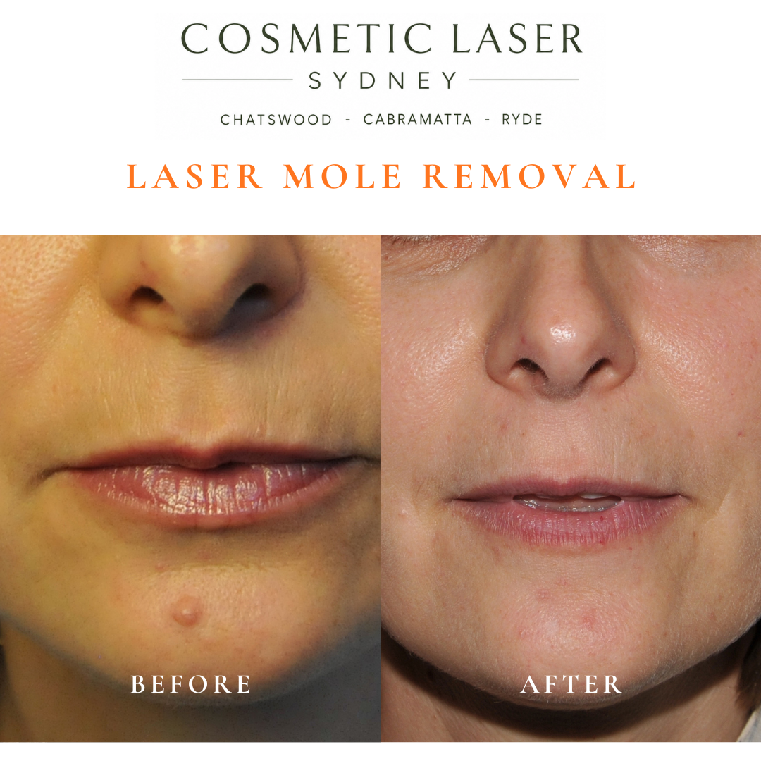 A mole on the chin was removed using laser mole removal. The procedure was performed with precision to achieve an excellent cosmetic result while minimising the risk of scarring.