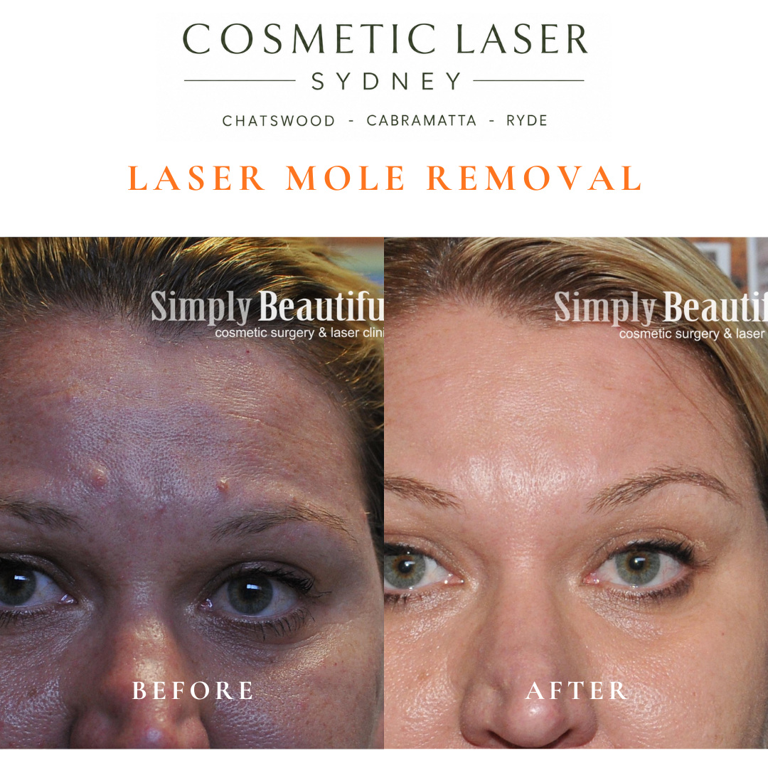 Three facial moles and sebaceous hyperplasia of the glabella treated with laser mole removal.
