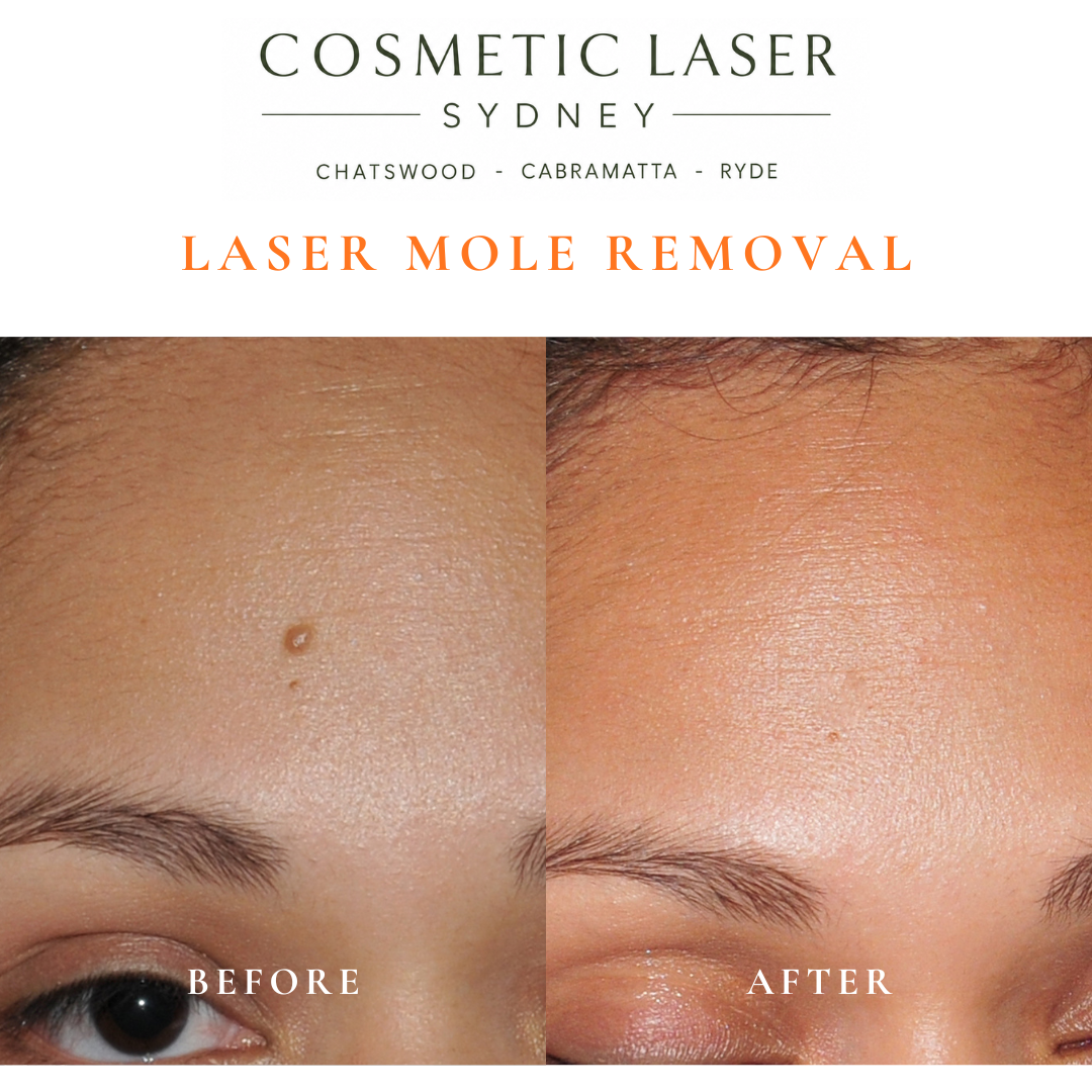 This single mole on the forehead was causing irritation for the patient. It was successfully removed using our laser mole removal technique, achieving an excellent cosmetic outcome with minimal downtime.