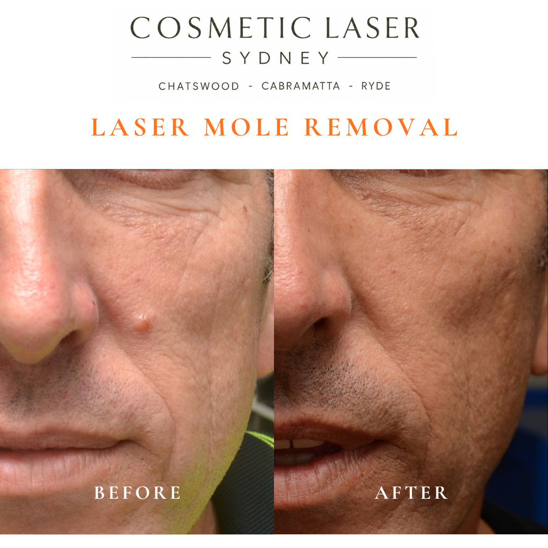 Mole on the mid-face treated with laser mole removal.