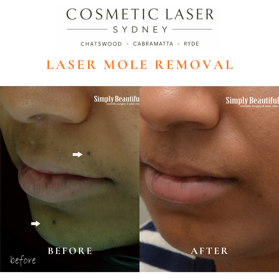 Multple moles near the mouth area removed with our laser mole removal technique.