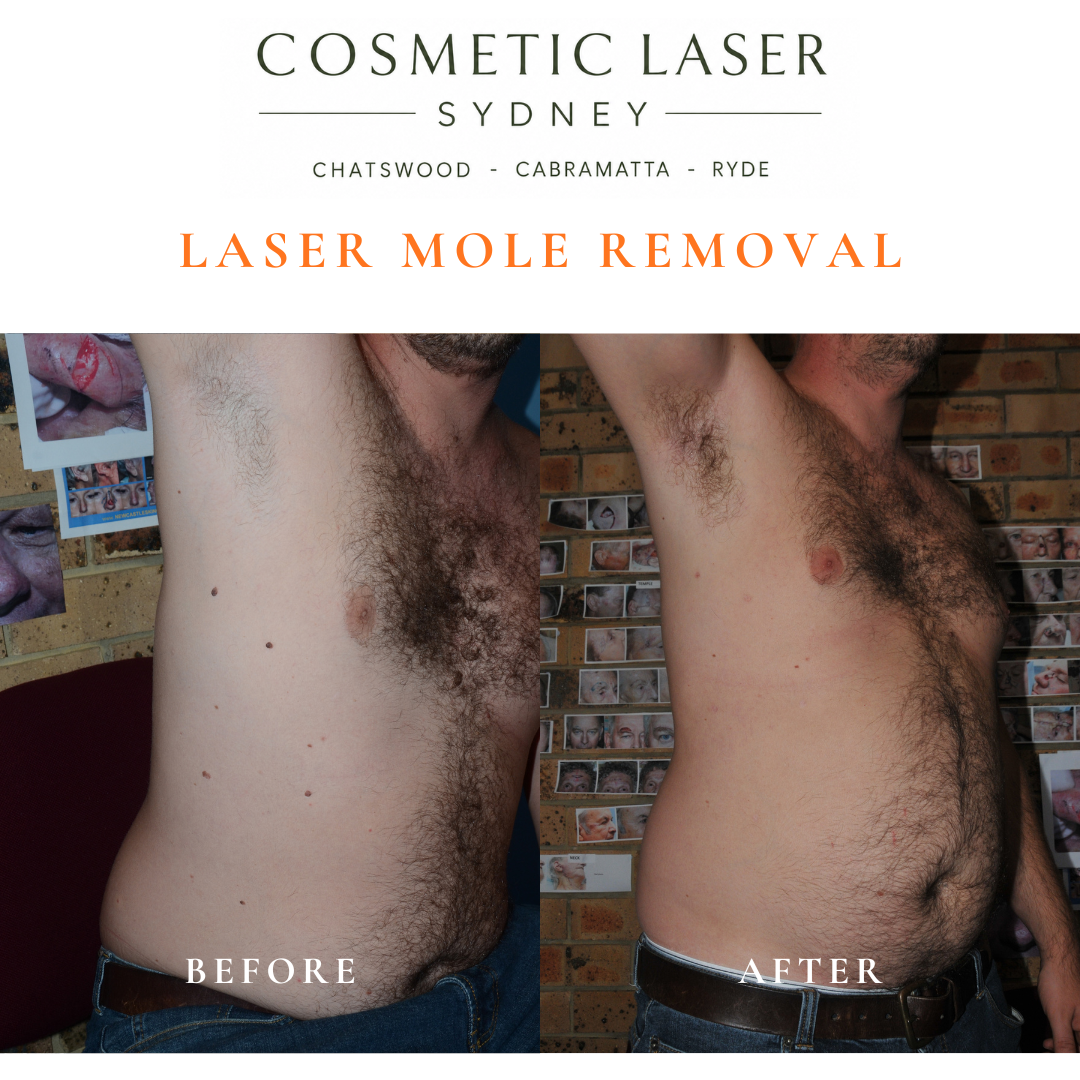 Multiple body moles treated with laser mole removal.