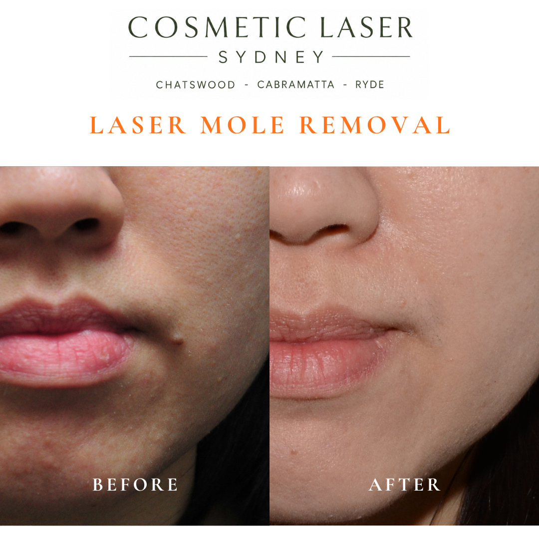 Mole at the corner of the lip treated with laser mole removal.