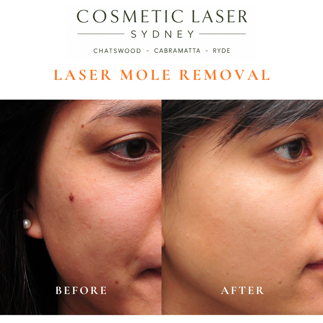Mole from the cheek removed with laser mole removal.