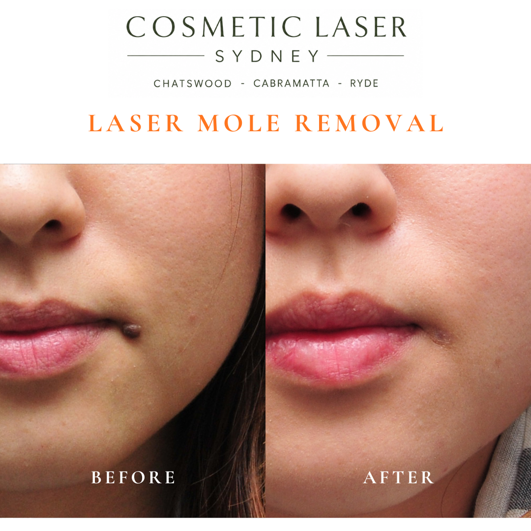 A mole at the corner of the lip was removed using laser mole removal. This delicate area requires precise treatment to achieve the best cosmetic outcome while minimising the risk of scarring.